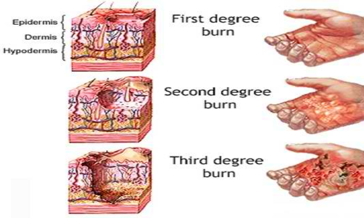 3rd degree burn scar hand